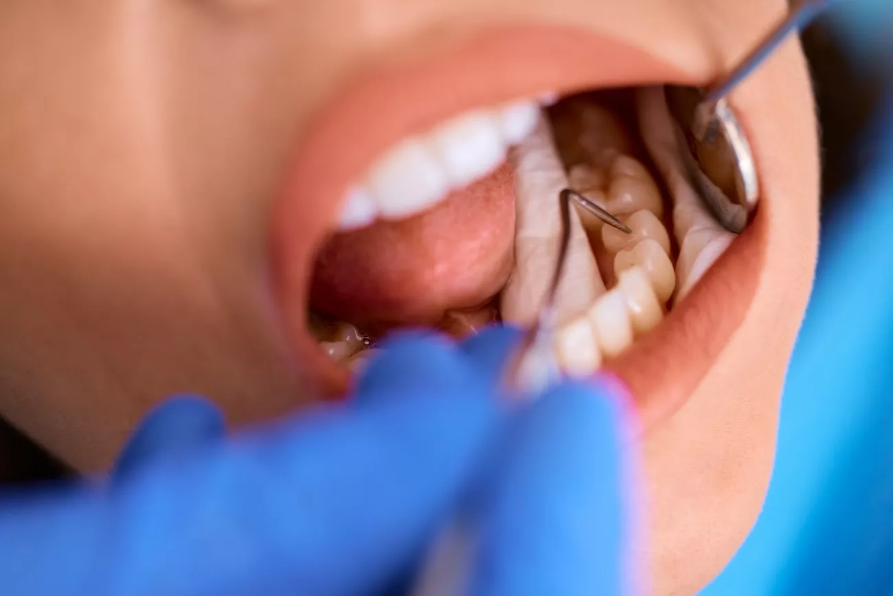 A dental patient getting her teeth checked before a dental filling procedure.