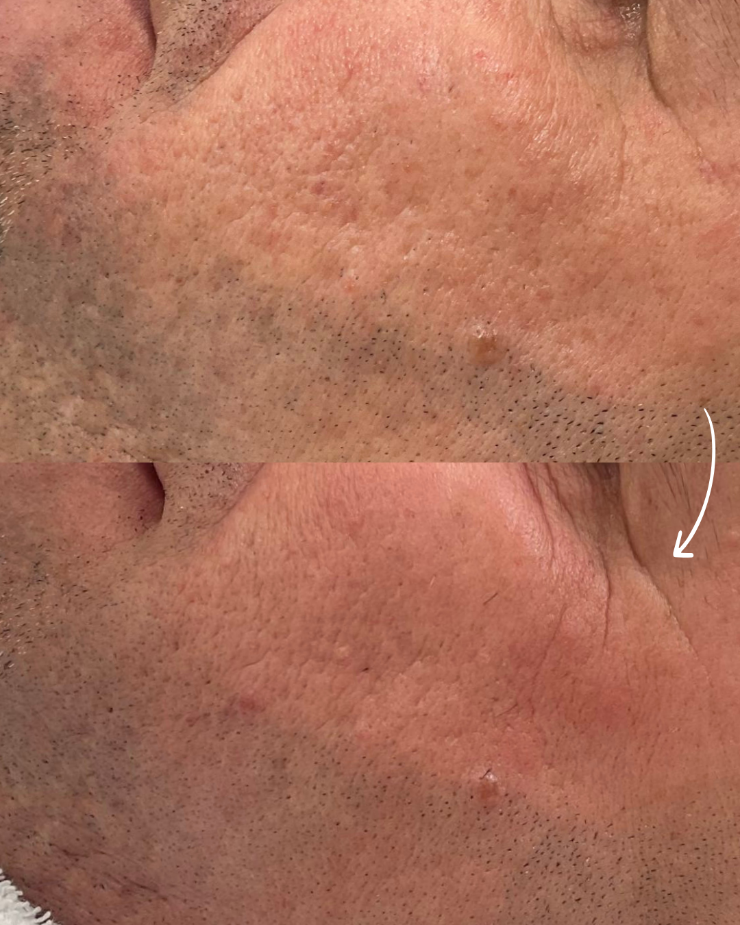 Voor en na resultaat van acnelittekens behandeld met Fractional laser
