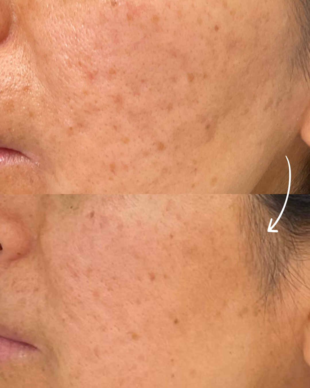 Voor en na resultaat van acnelittekens behandeld met microneedling