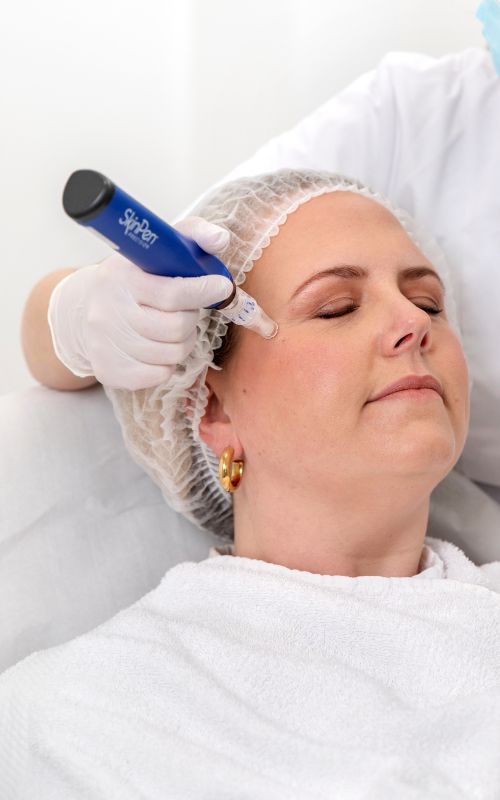 Microneedlingbehandeling voor littekens