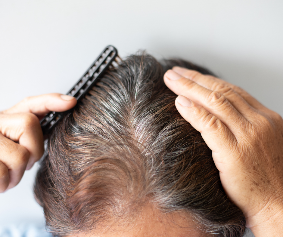 microneedling for hair loss