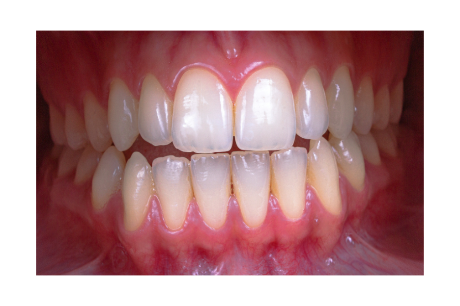 Close-up of upper and lower front teeth showing the gum line and visible gum tissue above the upper teeth.