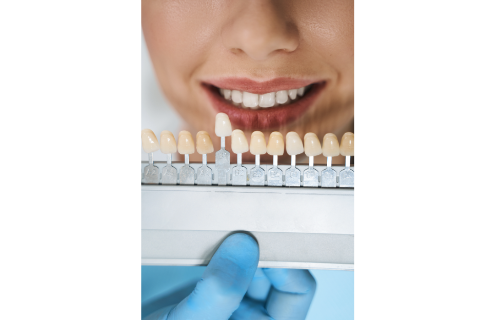 Close-up of a smiling patient behind a dental shade guide, with a clinician’s gloved hand holding tooth color samples to compare veneer shades.