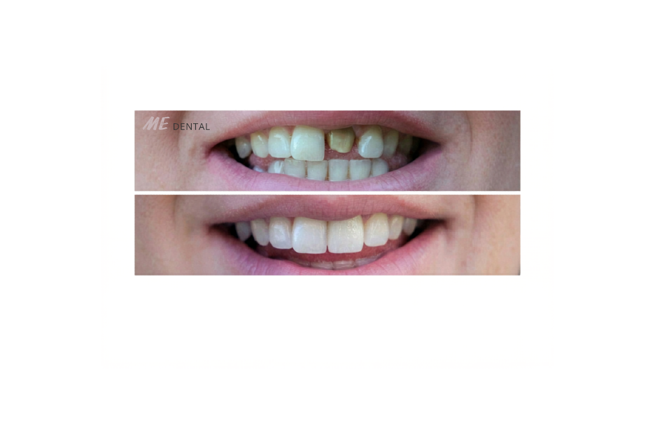 Before-and-after close-up of a patient’s smile, with the top image showing uneven, discolored front teeth and the bottom image showing a brighter, more even smile after treatment.