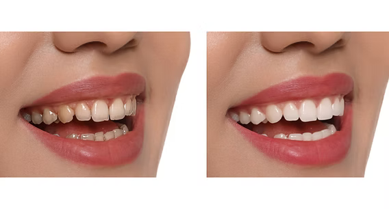 Porcelain veneers before and after smile makeover in San Francisco