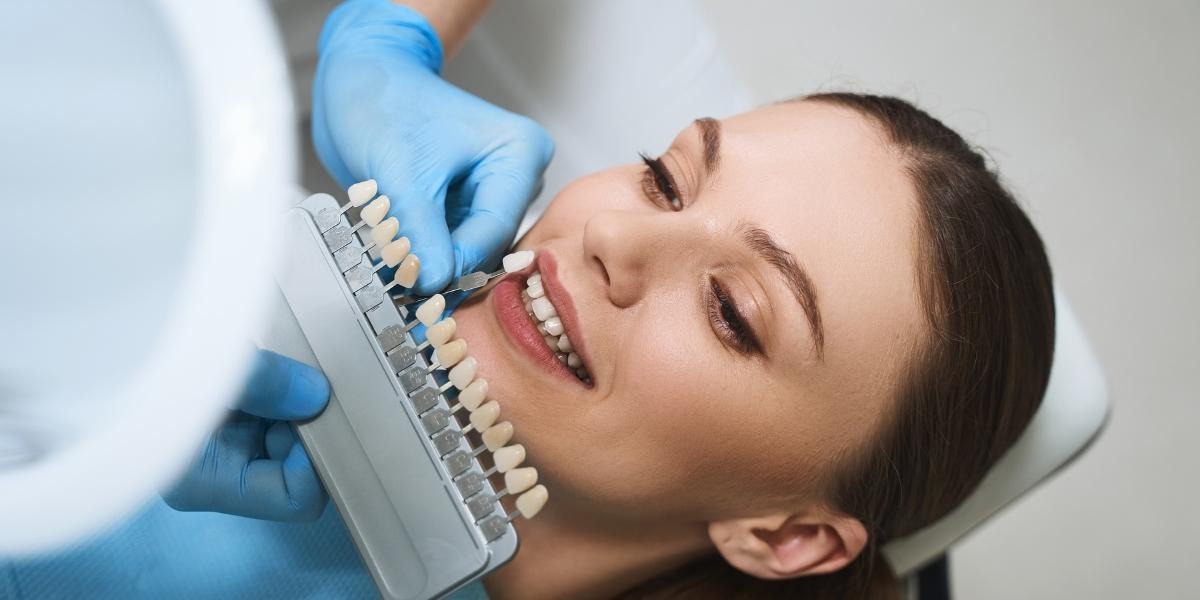 Porcelain veneers in San Francisco for a natural Hollywood smile
