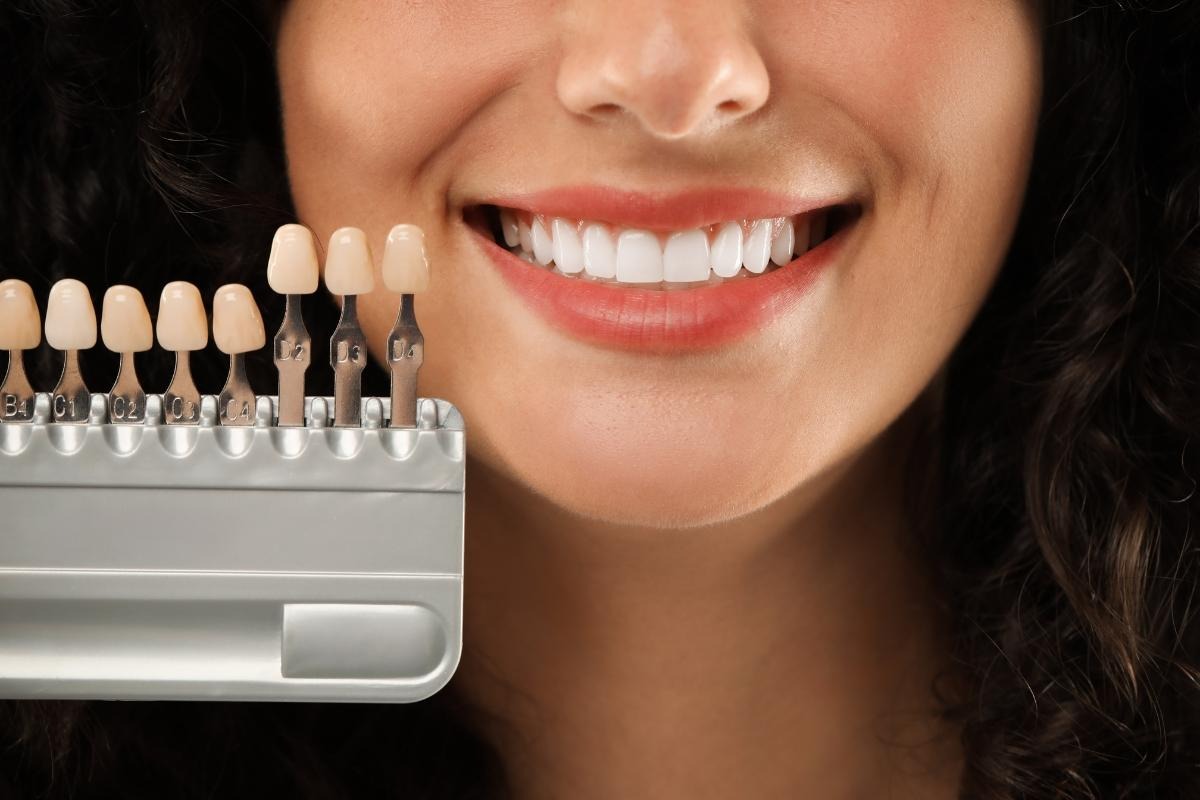 Dental veneers in San Francisco for cosmetic smile improvement