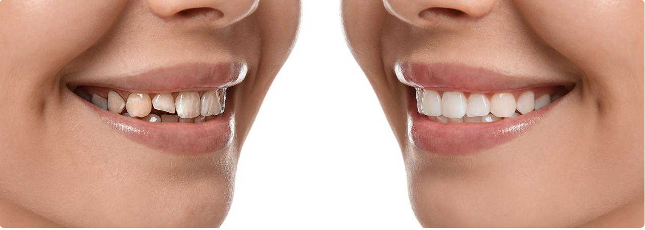 Porcelain veneers before and after smile makeover in San Francisco