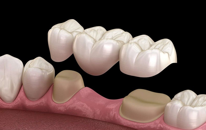 Dental bridge replacing missing teeth