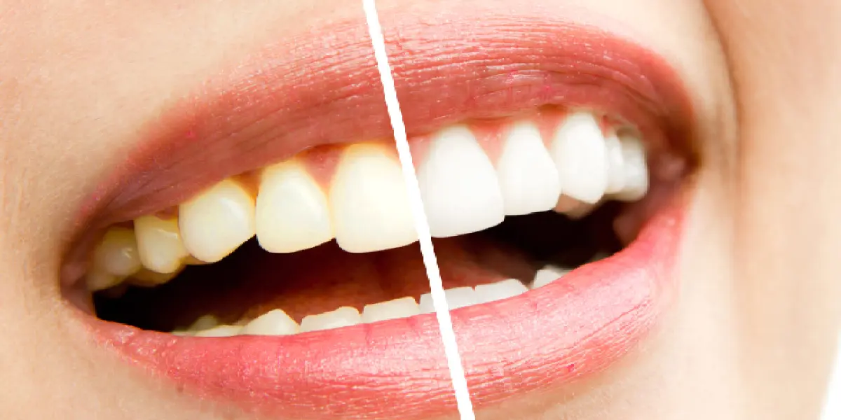 Dental veneers smile