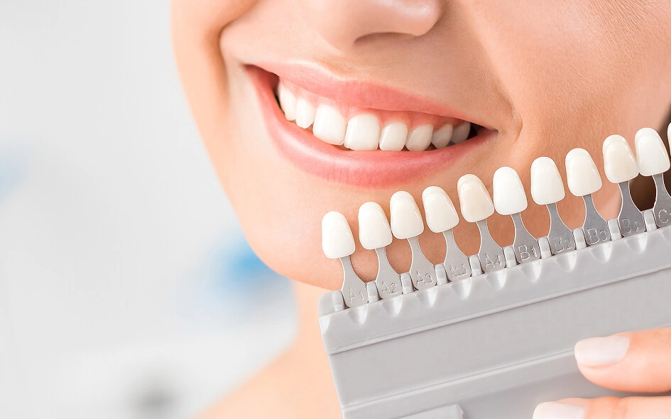 Custom porcelain veneers matched to natural teeth in San Francisco
