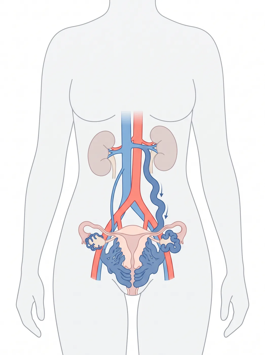 Varices pelviennes : la veine ovarienne gauche circule à l'envers et les veines du pelvis sont dilatées.
