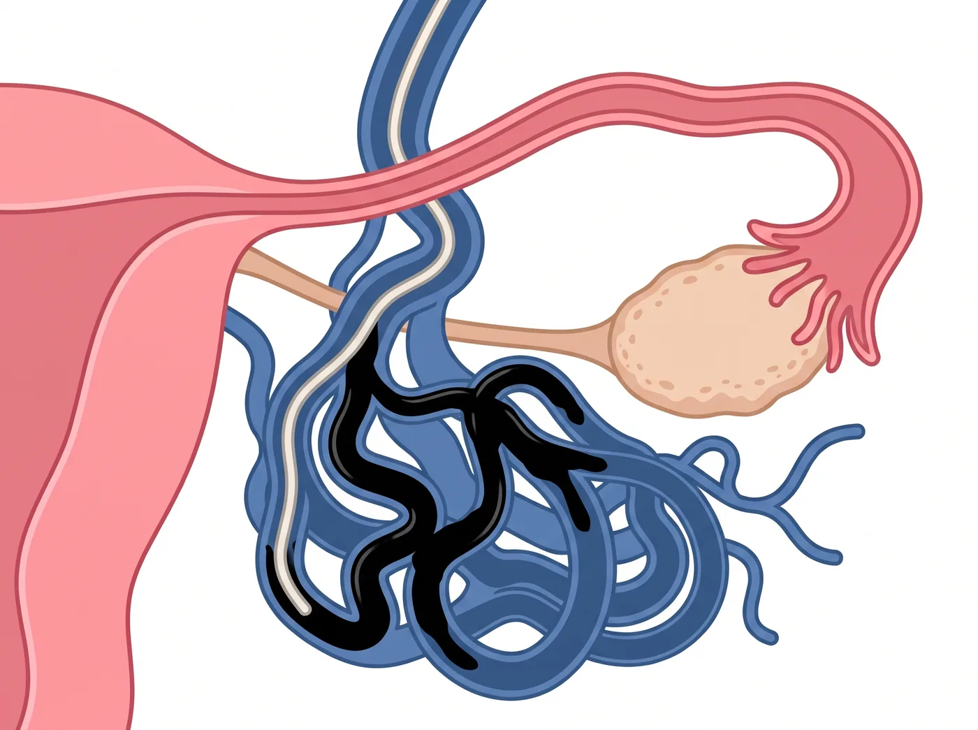 Un produit d'embolisation semblable à de la colle est injecté dans les varices pour les boucher, sous contrôle radiologique.