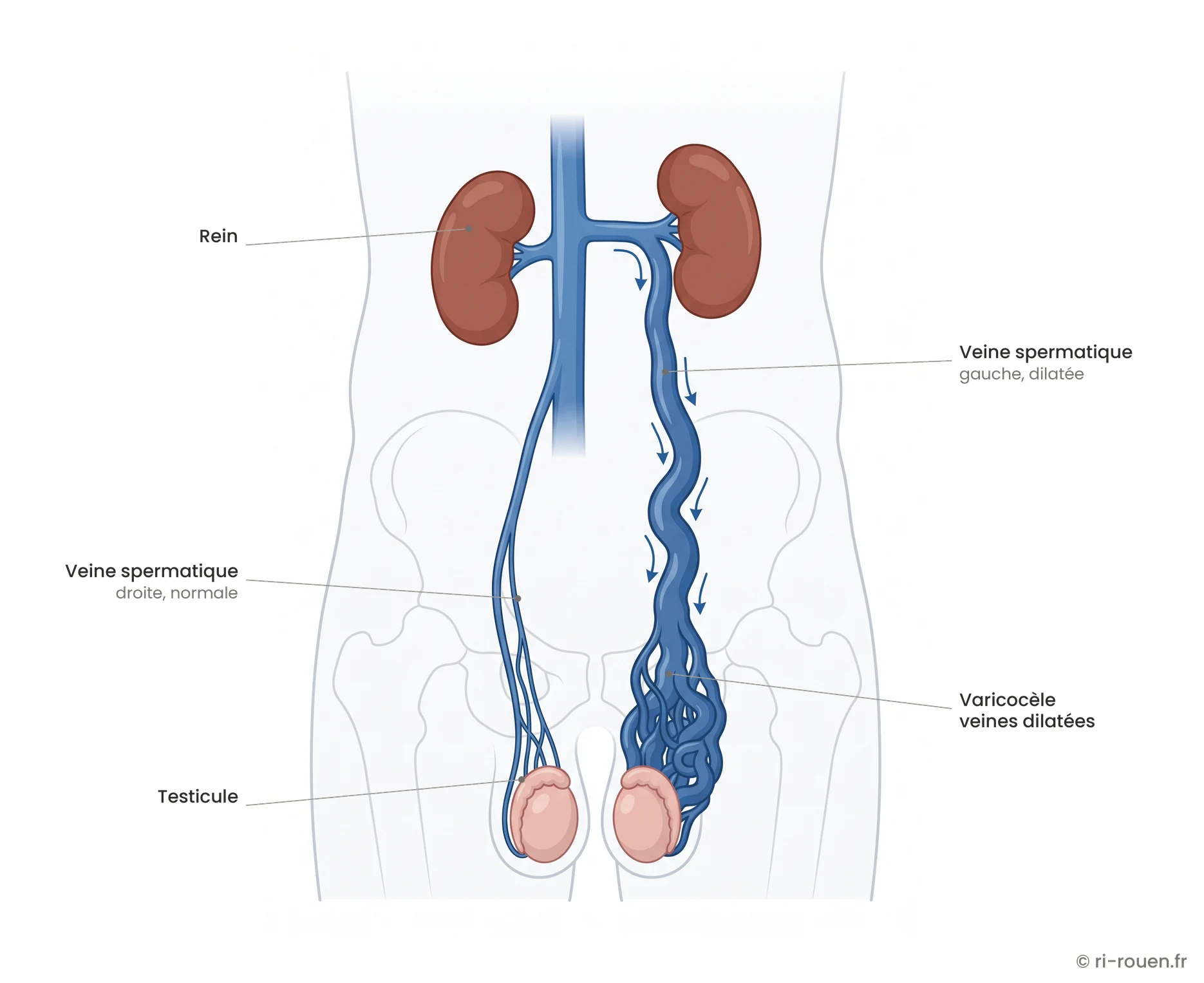 Schéma anatomique de la varicocèle : dilatation de la veine spermatique gauche et des veines autour du testicule gauche.