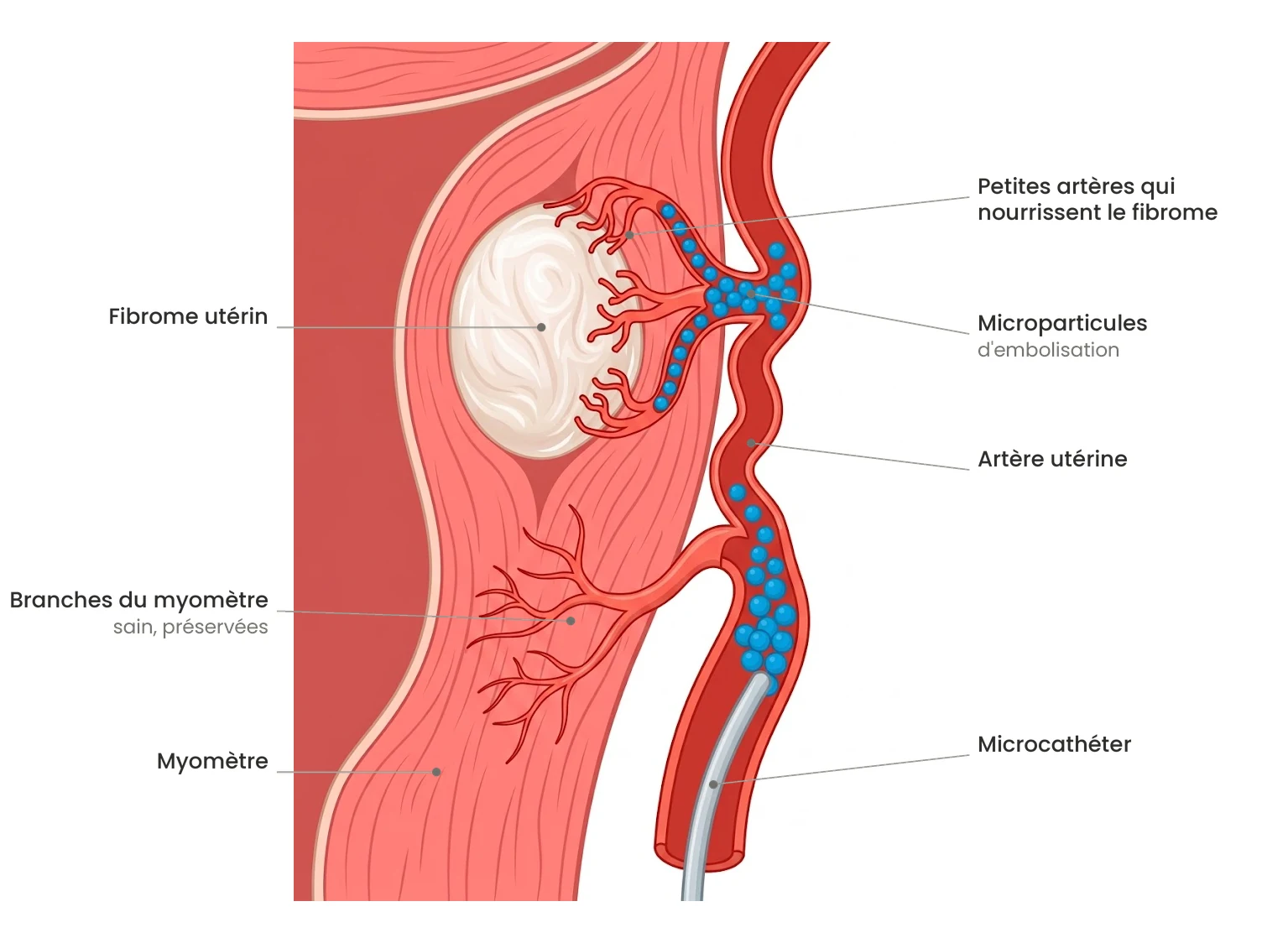 Schéma en coupe de l'embolisation d'un fibrome utérin : microcathéter dans l'artère utérine et microparticules occluant les branches nourricières du fibrome.