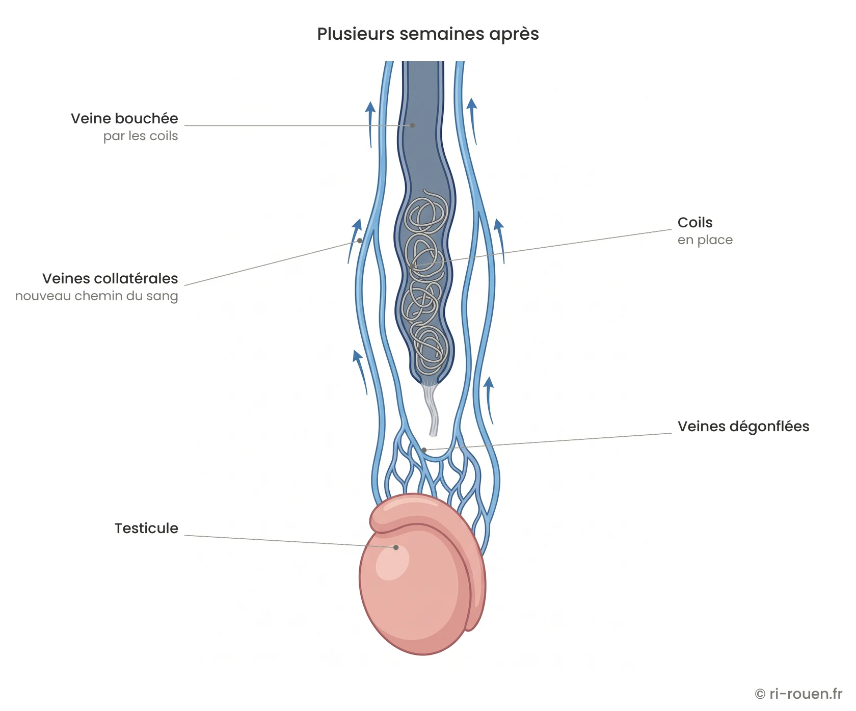 Résultat plusieurs semaines après embolisation : veine bouchée par les coils et drainage du testicule par des veines collatérales.