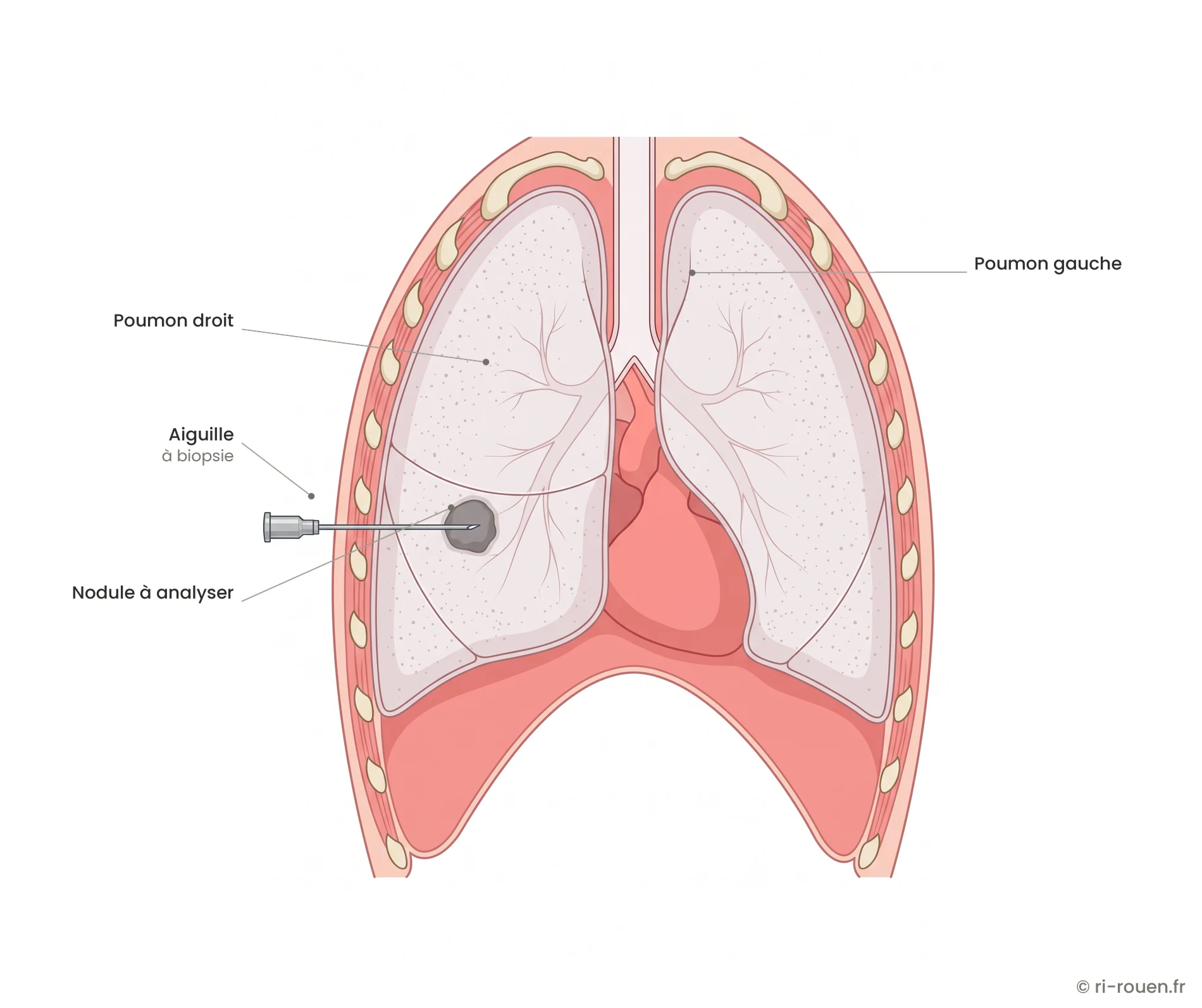 Schéma de biopsie pulmonaire percutanée : trajet de l'aiguille entre deux côtes jusqu'à un nodule du poumon droit.