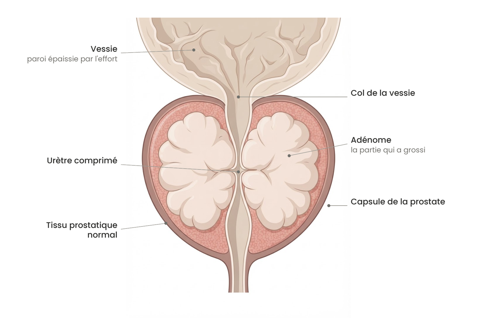 Schéma anatomique expliquant comment la prostate hypertrophique comprime l'urètre.