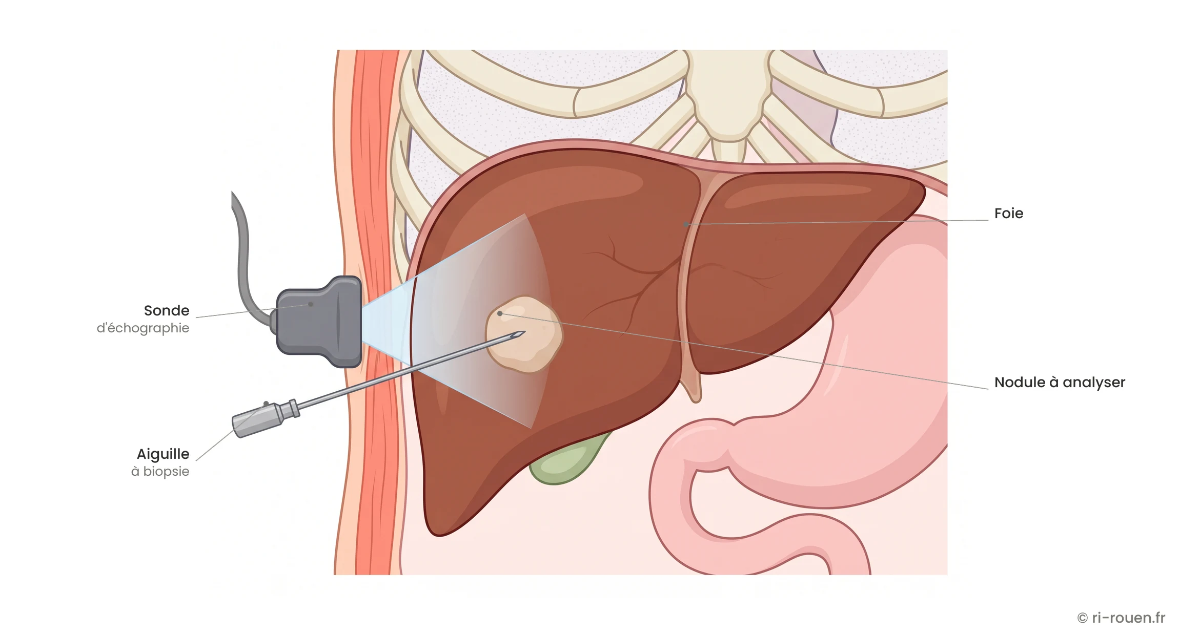 Biopsie du foie sous échographie : la sonde posée sur la peau permet de suivre l'aiguille en temps réel jusqu'à la lésion.