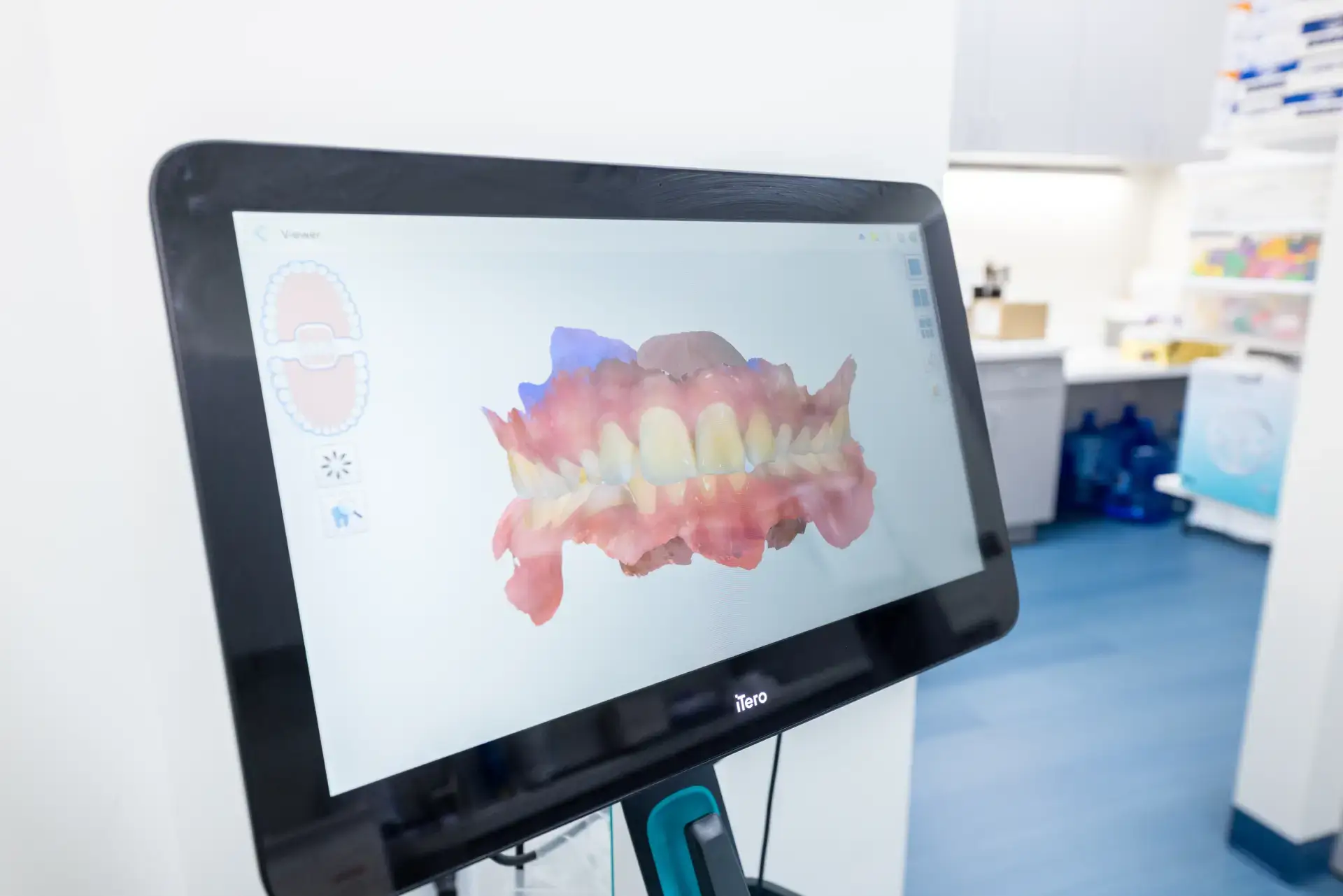 Digital 3D scan of teeth and gums displayed on an iTero dental scanner screen in a clinical setting.