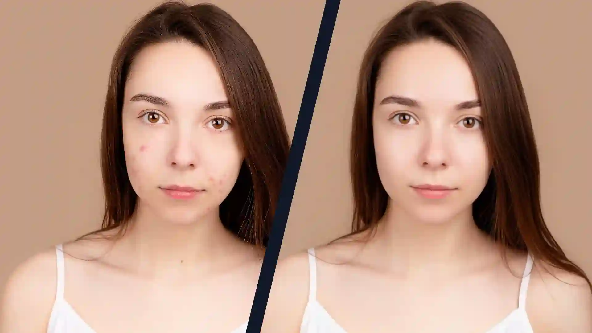 photo of a girl getting her blemishes removed, a before and after thanks to using the best blemish remover apps in 2026
