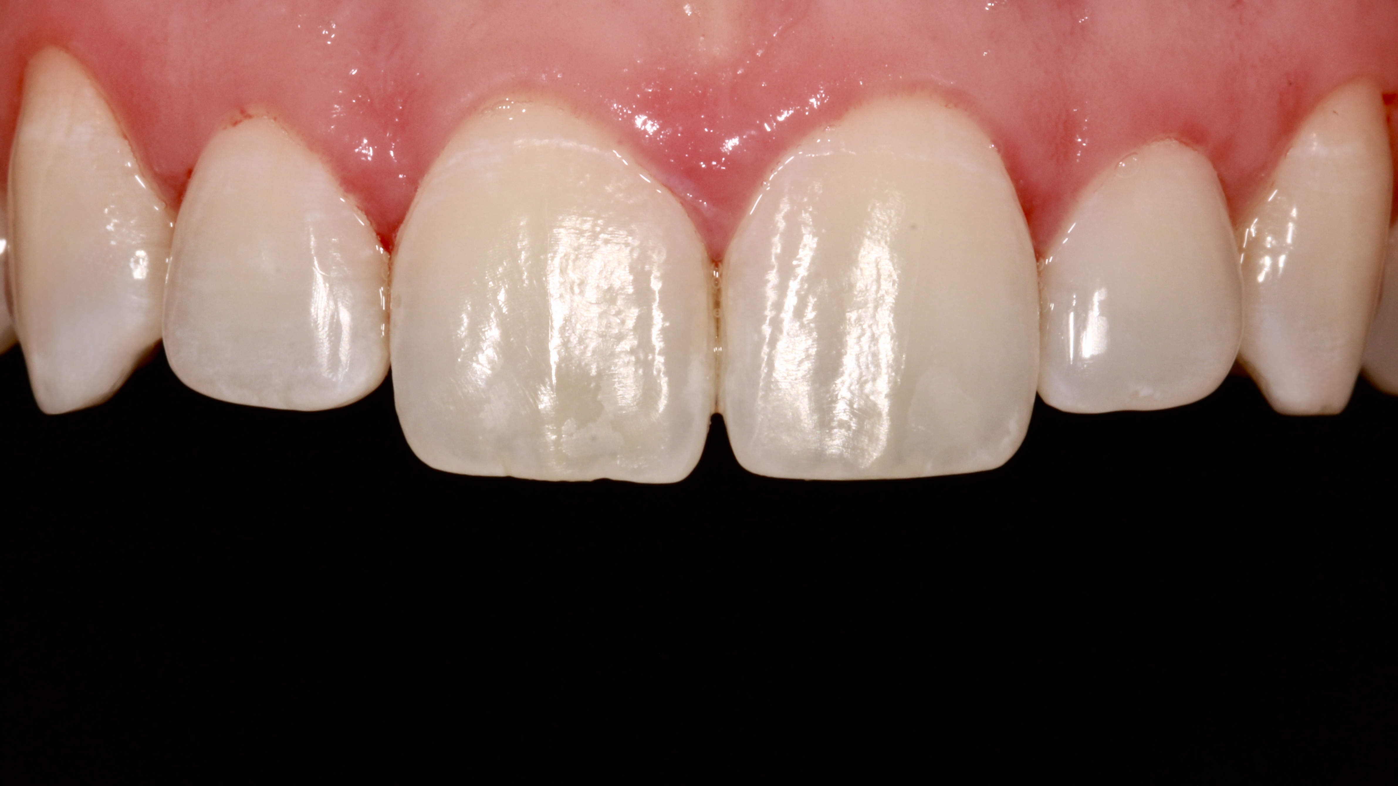 Upper front teeth after cosmetic treatment, with even edges and healthy pink gums