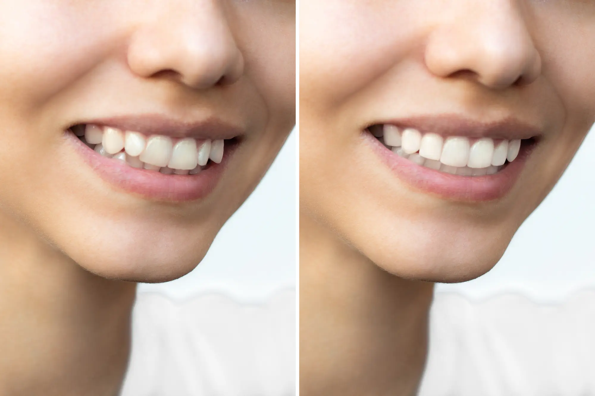 Can Veneers Fix Crooked Teeth? Transform Your Smile with Precision and Ease