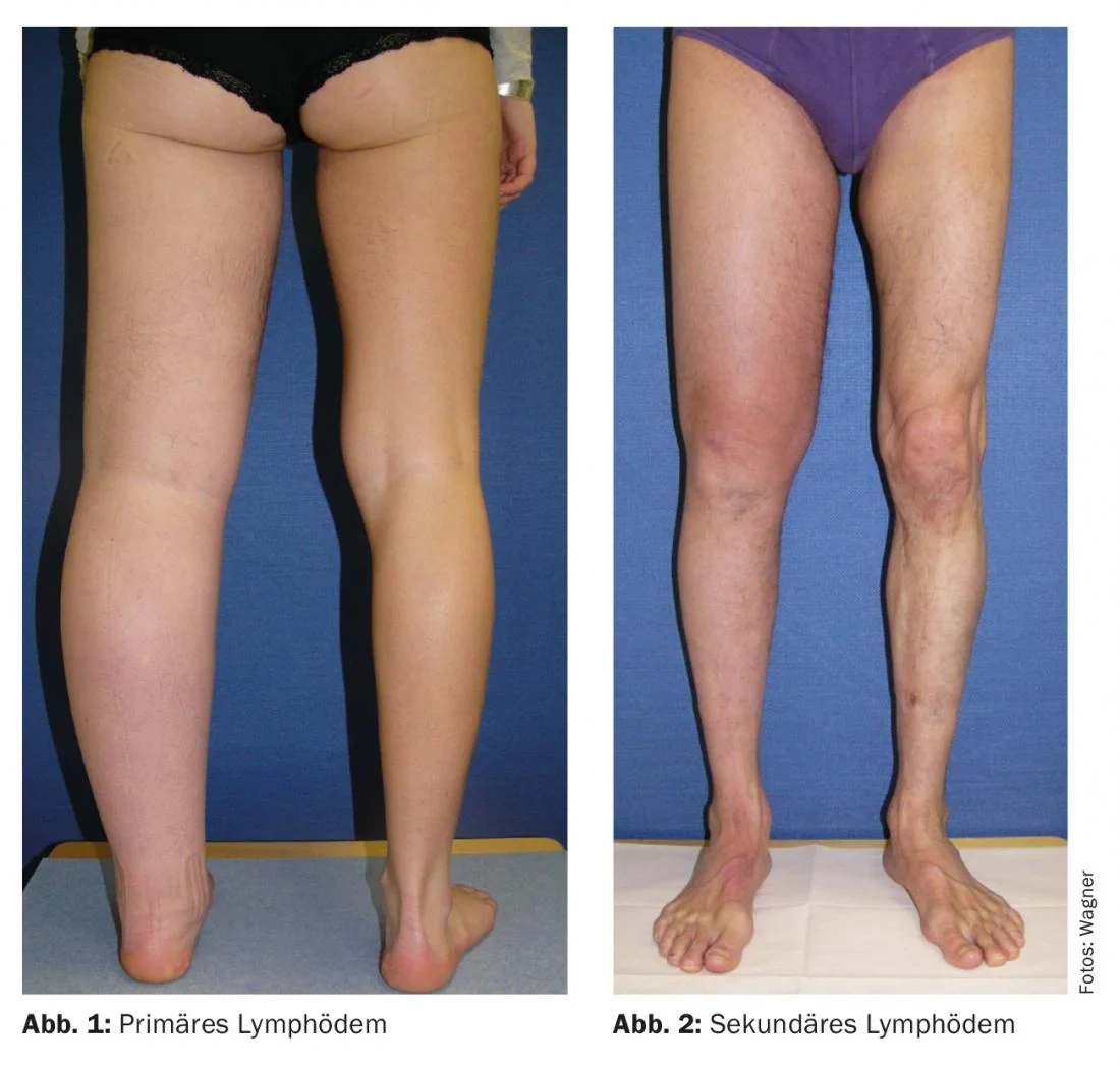 Linfedema