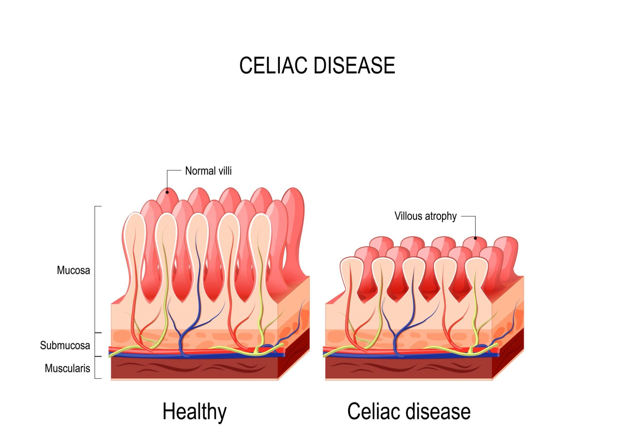 Celiachia e riduzione assorbimento
