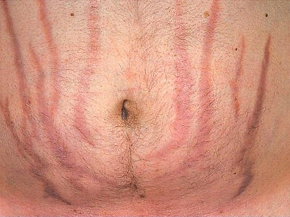 Sindrome di Cushing e striature violacee