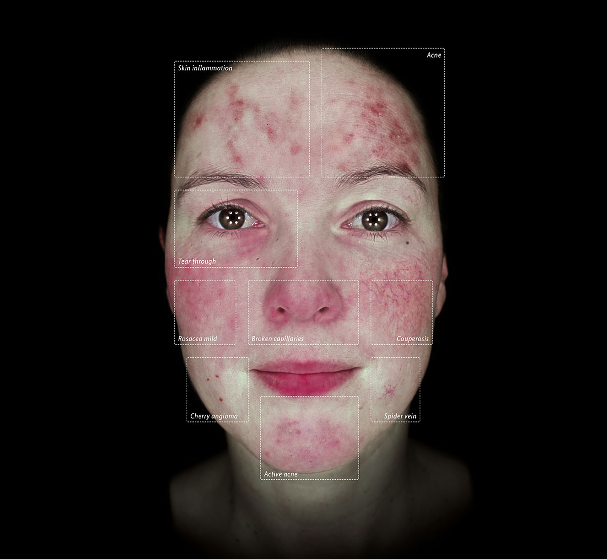 Alma IQ skin analysis report showing skin vascularity