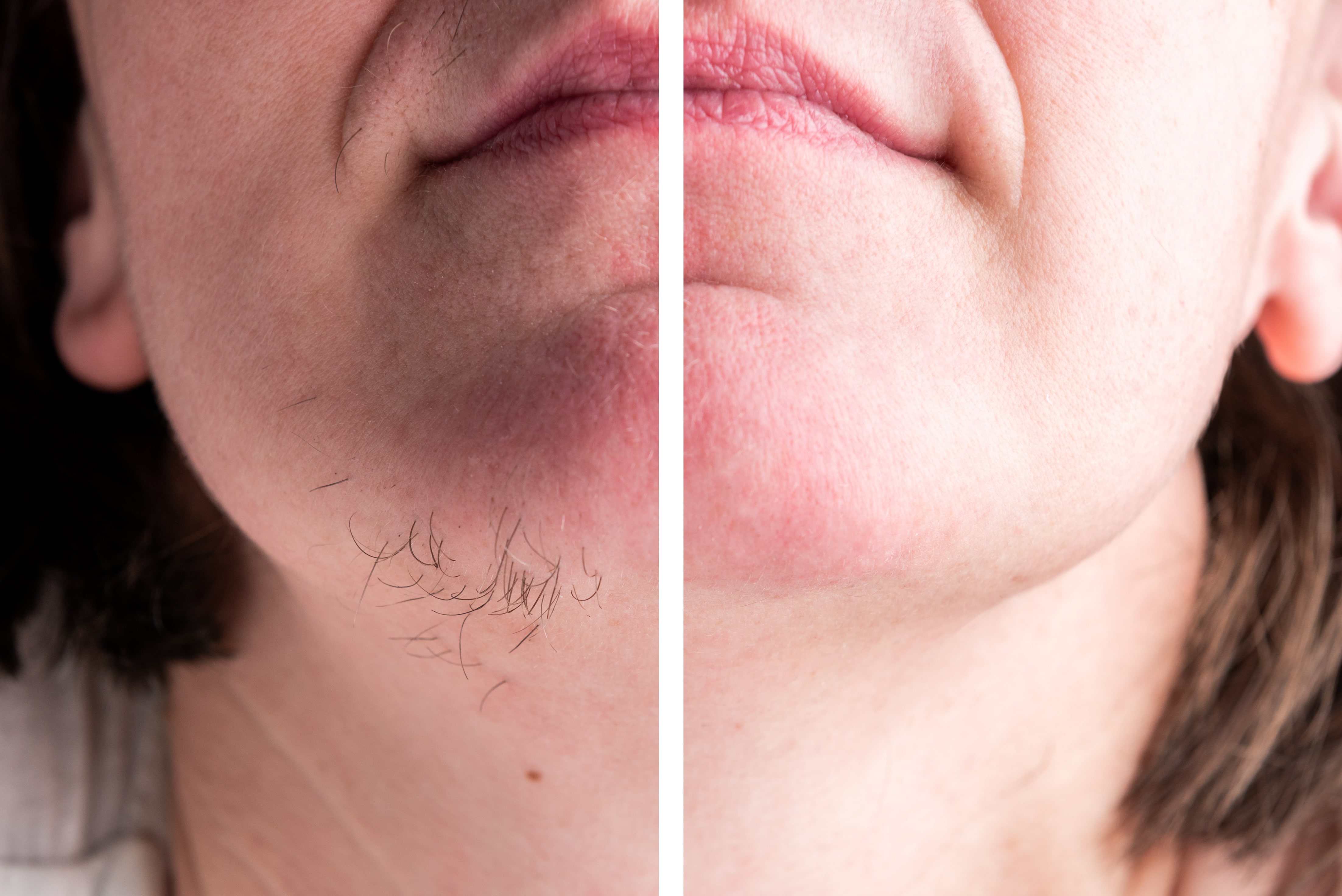 Patient preparing for a first laser hair removal session