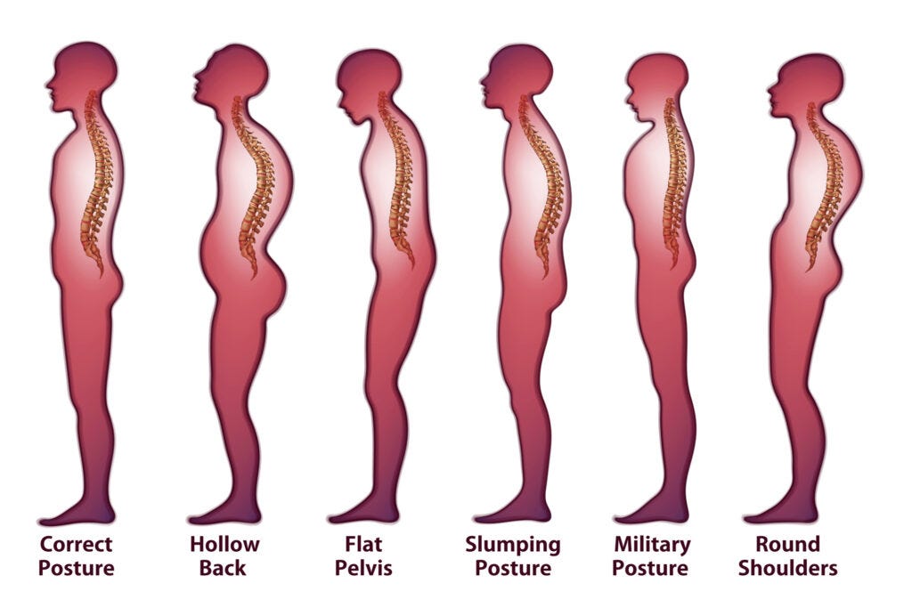 Diagram comparing six standing posture patterns