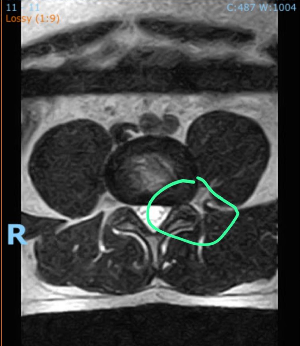 Cross-sectional spinal scan with a region marked in green