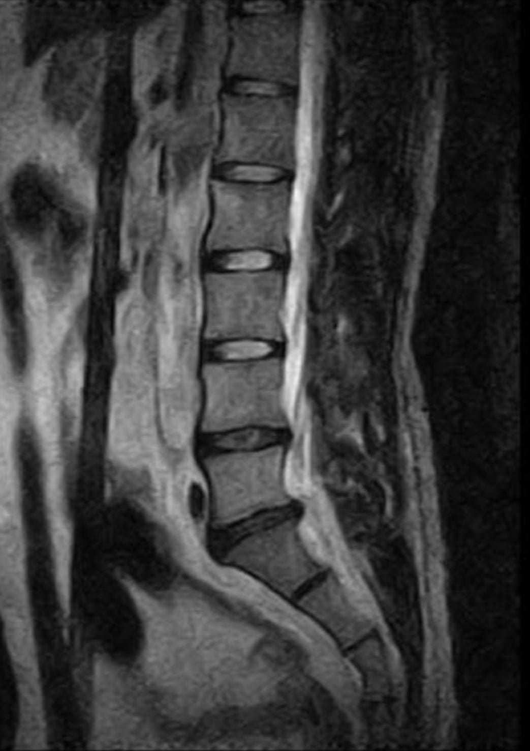 Lumbar spine scan reproduced in Taylor Rice's posture article