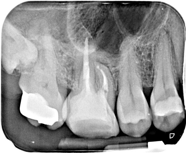A x-ray of teethDescription automatically generated