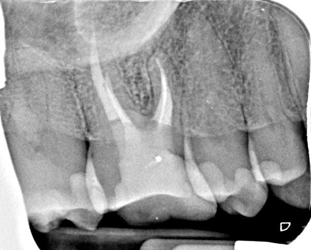 A close-up of a tooth x-rayDescription automatically generated