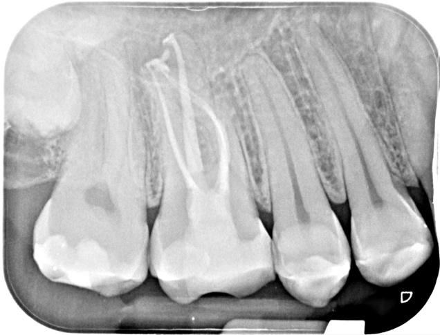 A x-ray of teethDescription automatically generated