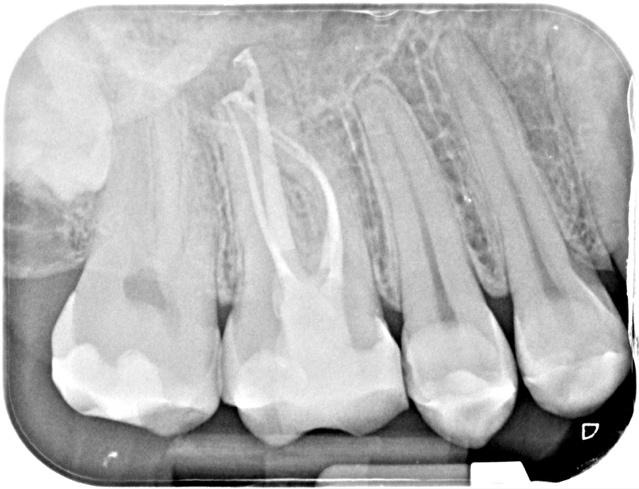 A x-ray of teethDescription automatically generated