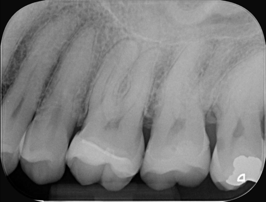 A x-ray of a human teethDescription automatically generated