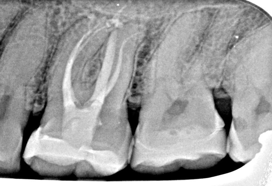 A close-up of a tooth x-rayDescription automatically generated