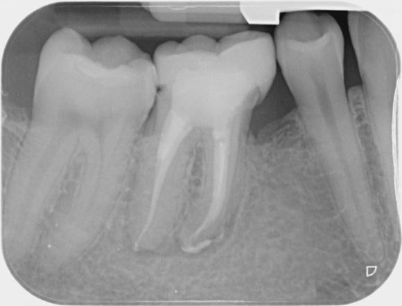 X-ray of teeth with teeth missingDescription automatically generated
