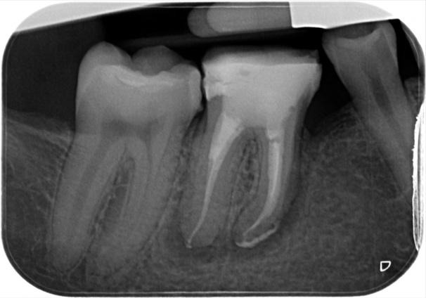 A close-up of a tooth x-rayDescription automatically generated