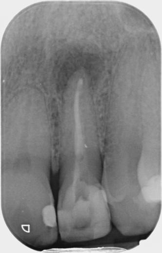 A close-up of a tooth x-rayDescription automatically generated
