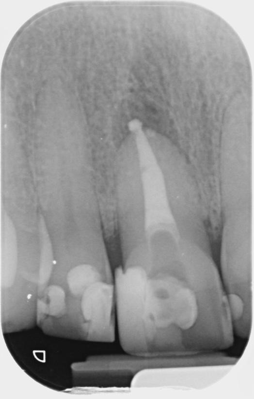 A close-up of a tooth x-rayDescription automatically generated