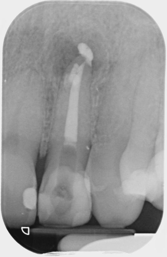 A close-up of a tooth x-rayDescription automatically generated