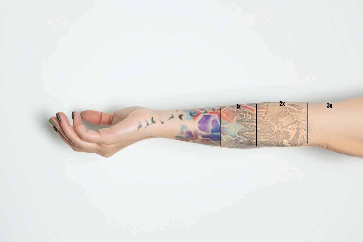 Tattoo removal