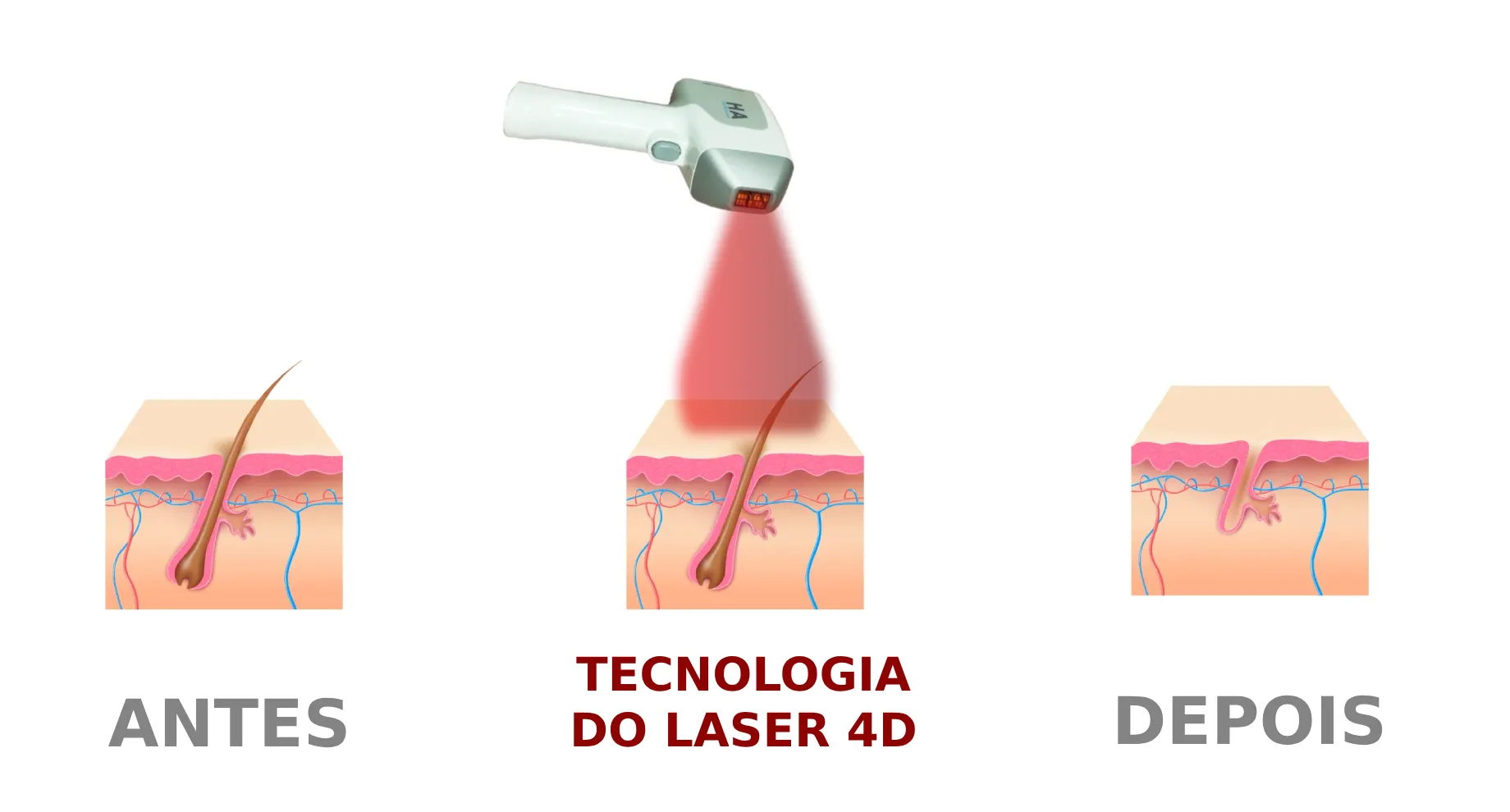Ilustração que demonstra como a tecnologia do Laser 4D atua na raiz do pelo para uma depilação definitiva.