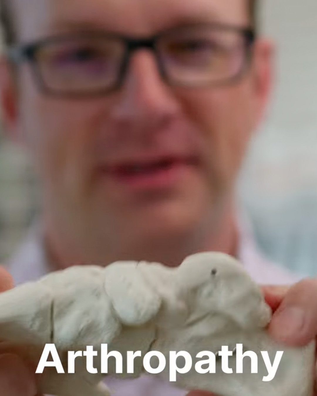 Did you know your feet are kind of like Legos? 🦶 Each bone is a piece that needs to fit together just right. When conditions like Charcot Arthropathy weaken the bones and joints, that structure can collapse—causing pain, deformity, and instability. Early diagnosis and treatment are key to keeping your “Lego feet” strong and aligned. At Idaho Foot & Ankle Center, we’re here to help you protect every piece. 💙