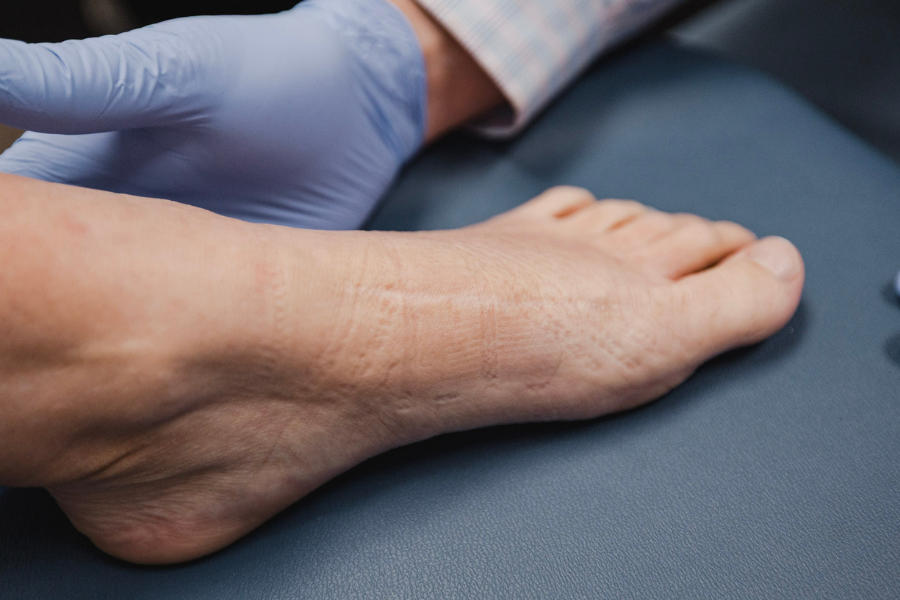 Close-up of a podiatrist examining the side of a patient’s foot during a medical evaluation for foot pain or structural issues.